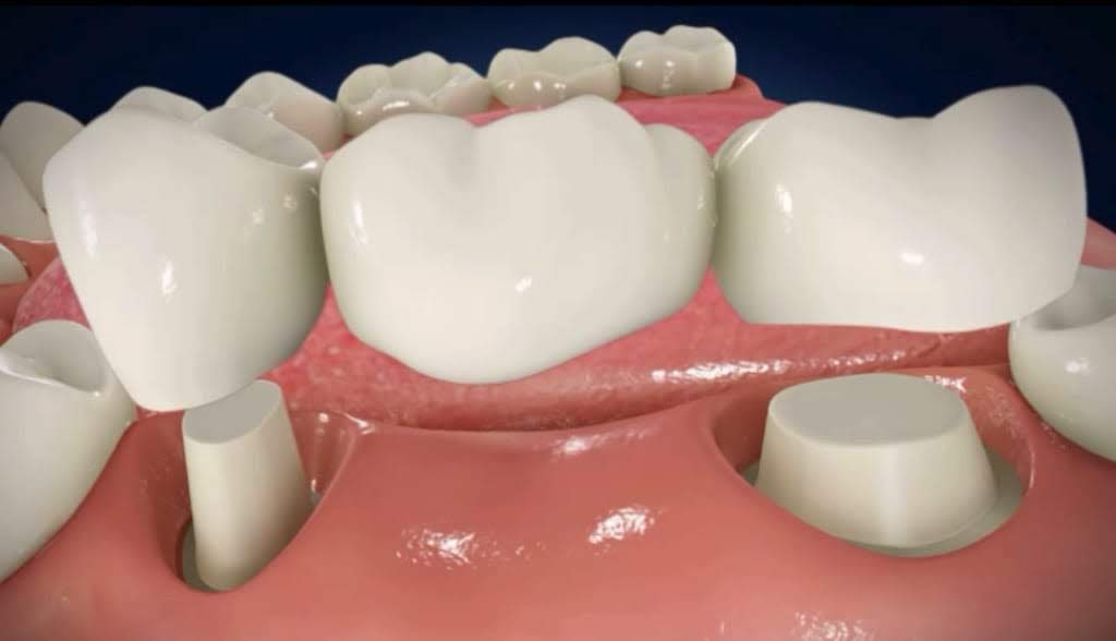 Best Dental implant in Satellite