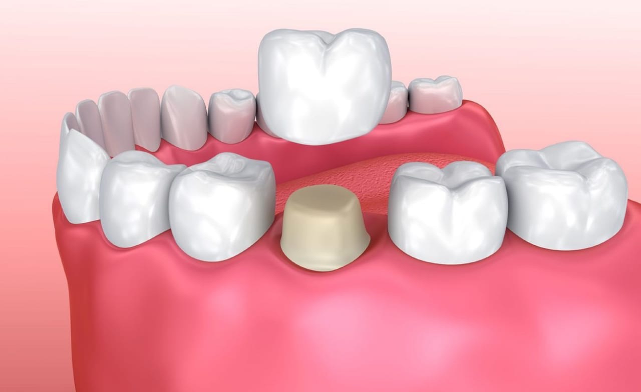 Esthetic dentistry in Ahmedabad