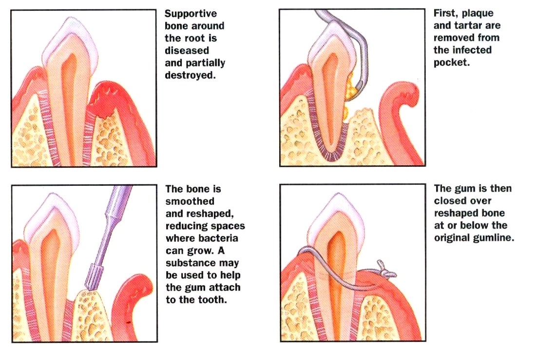 Periodontal Surgery in Ahmedabad