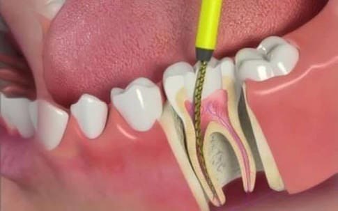 Root Canal Treatment in Satellite