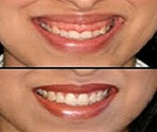 Smile Design in Ahmedabad