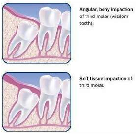 Teeth Whitening in Ahmedabad