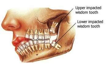 Full Mouth Rehabilitation Treatment In Ahmedabad